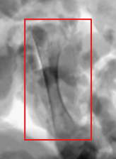 Close-up of the same bone-related region highlighted in the full poultry X-ray.