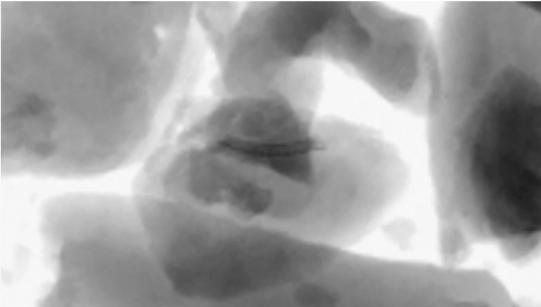 Magnified X-ray view of the detected bone fragment